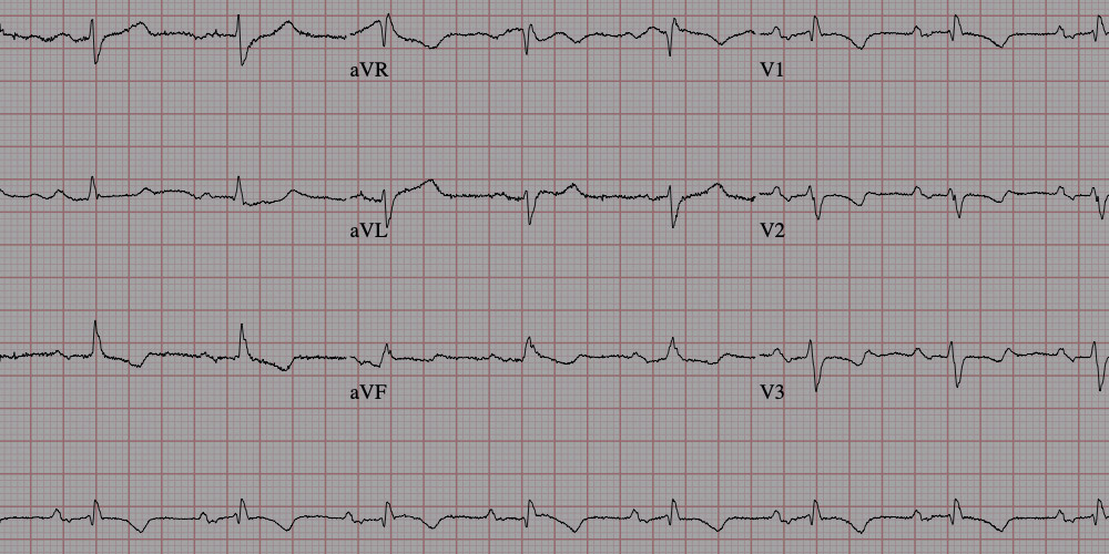 ECG or PPG? What are they and which is better?